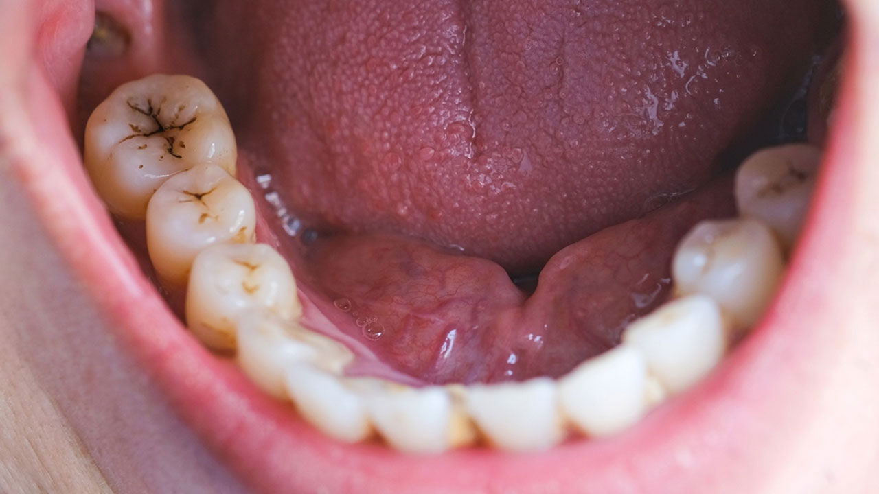 মুখে ক্যানসারের ঝুঁকি বাড়াচ্ছে দাঁতের ক্ষয়, বাঁচতে যা করবেন