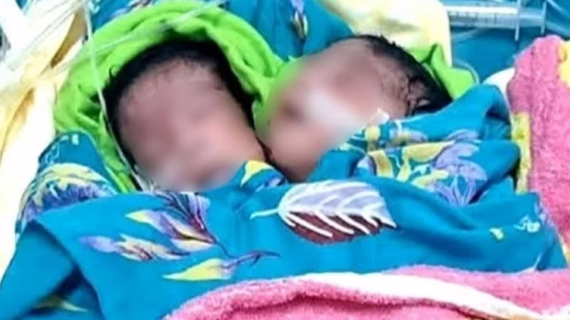 রাজশাহীতে দুই মাথা নিয়ে মেয়ে শিশুর জন্ম
